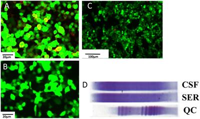 Paraneoplastic neuromyelitis optica spectrum disorder associated with ovarian dysgerminoma: a case report and literature review